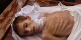 الطفل عبد العليم الخطيب ضحية للجوع و الحصار في معضمية الشام